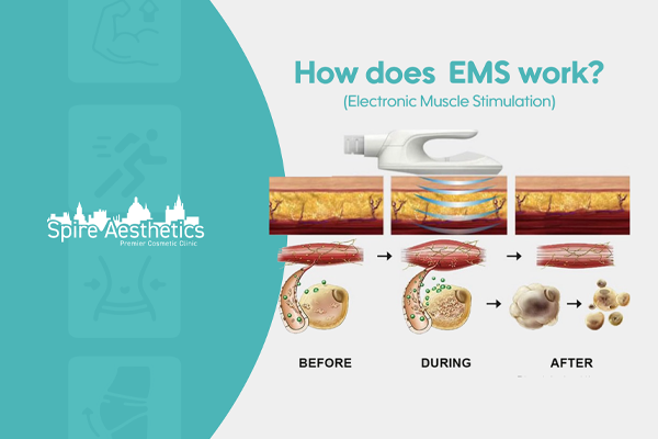 EMS treatment for post pregnancy weight loss treatment Rutherglen