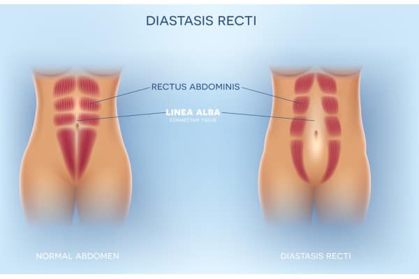 What Non-Surgical Options Are Available for Diastasis Recti Rutherglen?