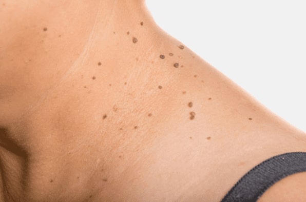 Are you looking for easy skin tag removal Rutherglen - then contact Spire today!