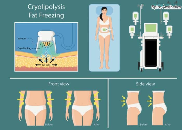 Image of diet and fat freezing combined for best results for Spire Aesthetics Rutherglen