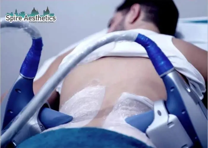 Man having fat freezing treatment done on love handles before a competitions Rutherglen to create a sculpted look.
