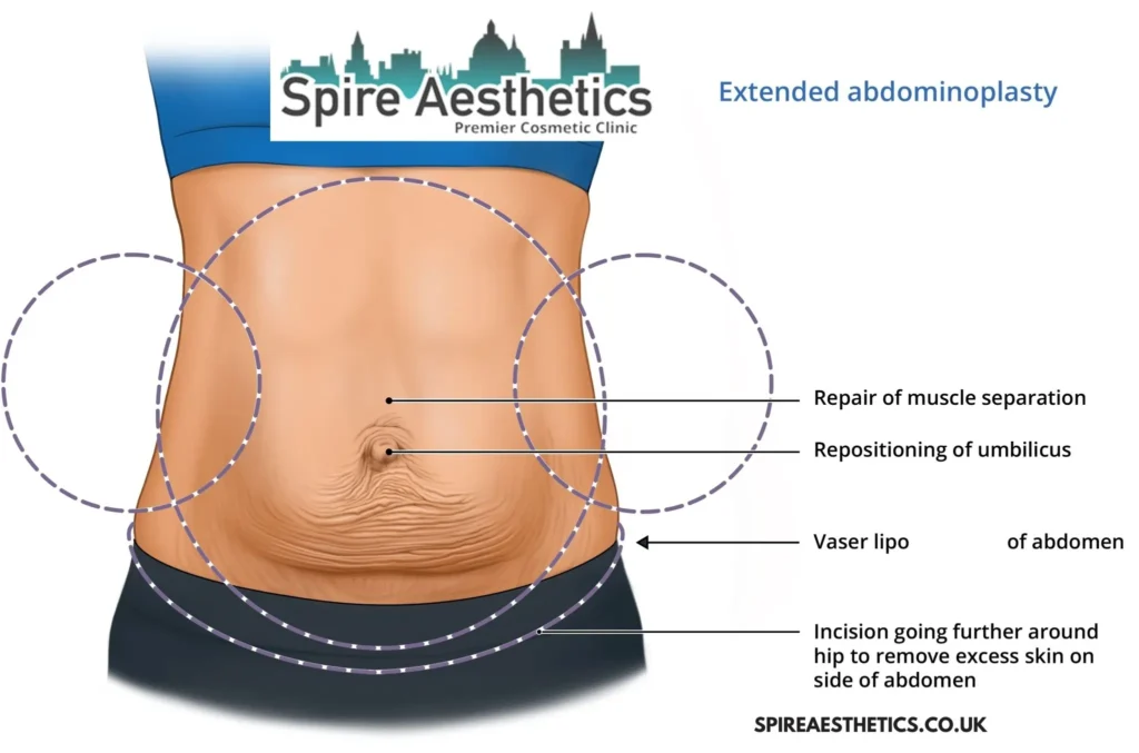 Understanding Loose Skin After Gastric Band Rutherglen Surgery and HIFU Treatment