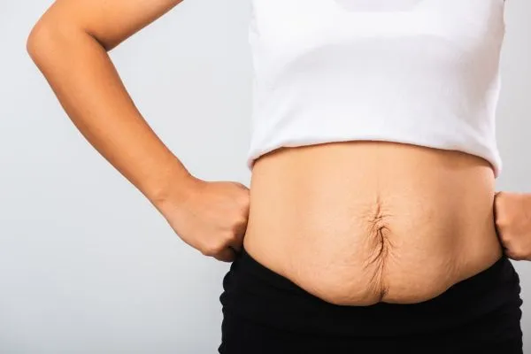 Image of a woman's stomach after weight loss with sagging skin following a gastric band Rutherglen