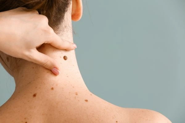 skin blemish removal Rutherglen treatment