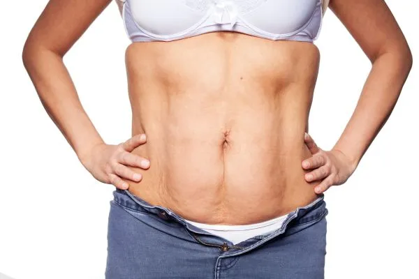 sagging skin on woman's stomach after weight loss injections Rutherglen