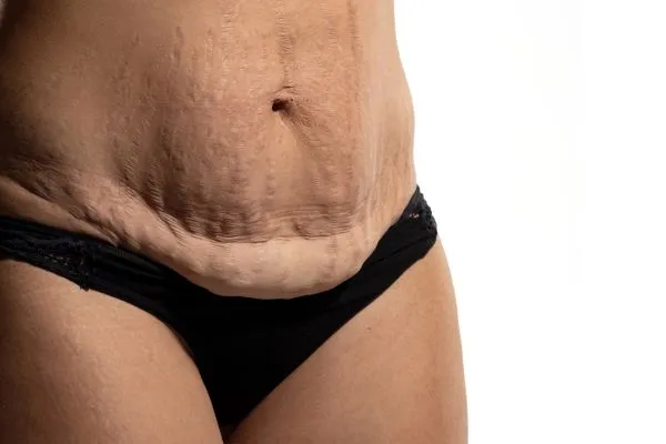 Image of womans stomach after weight loss injections Rutherglen showing saggy skin