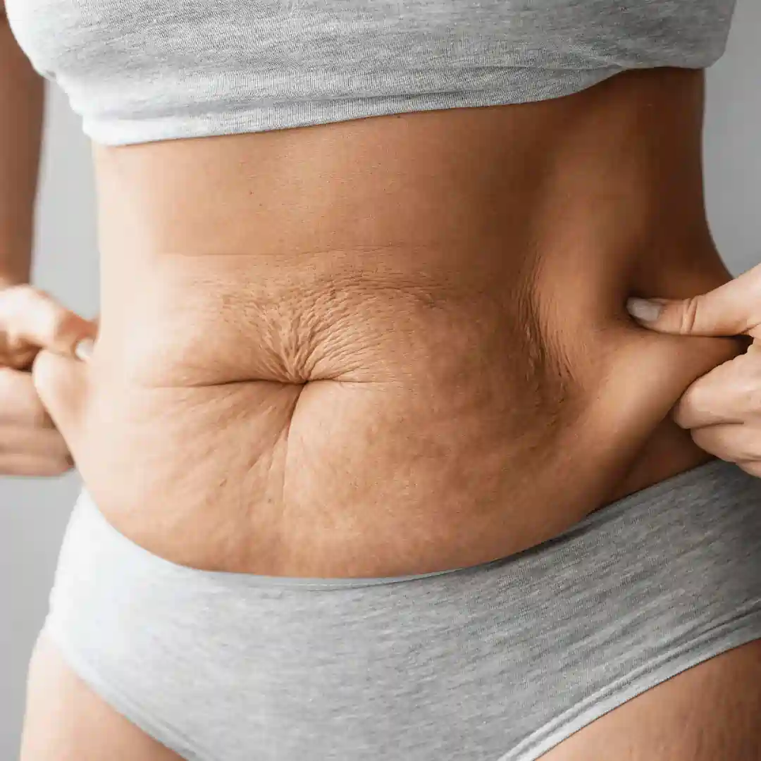 Is It Normal to Have Loose Skin After Pregnancy Rutherglen?